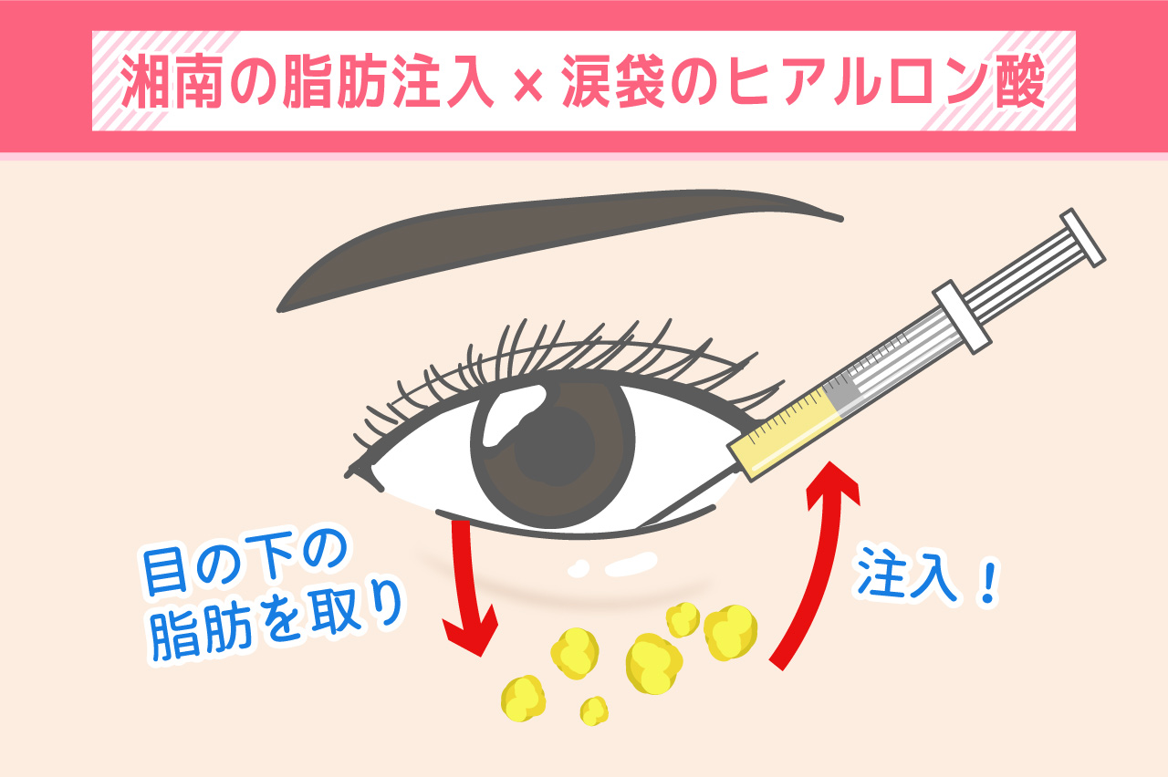 湘南の脂肪注入×涙袋のヒアルロン酸